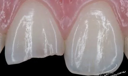 IV класс. Прямая реставрация резца