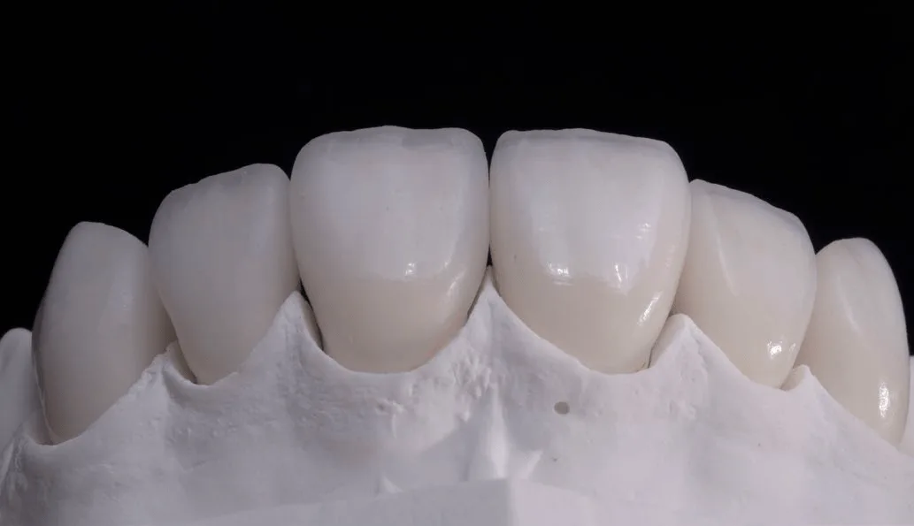 Harmony of smile design in the facial context